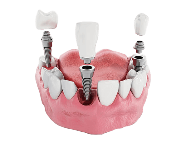 Port Jefferson Smiles-Karen Halpern DMD, MS-dental-implants-cutout