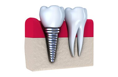 Port Jefferson Smiles - Karen Halpern DMD, MS - Dental Implants