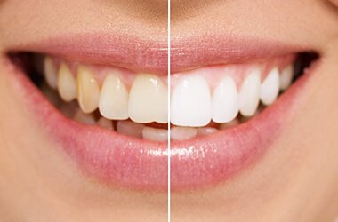 Port Jefferson Smiles - Karen Halpern DMD, MS - teeth whitening