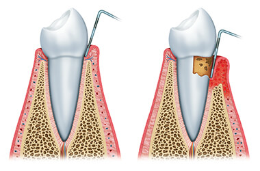Port Jefferson Smiles-Karen Halpern DMD, MS-non-surgical-treatment-periodontal-disease