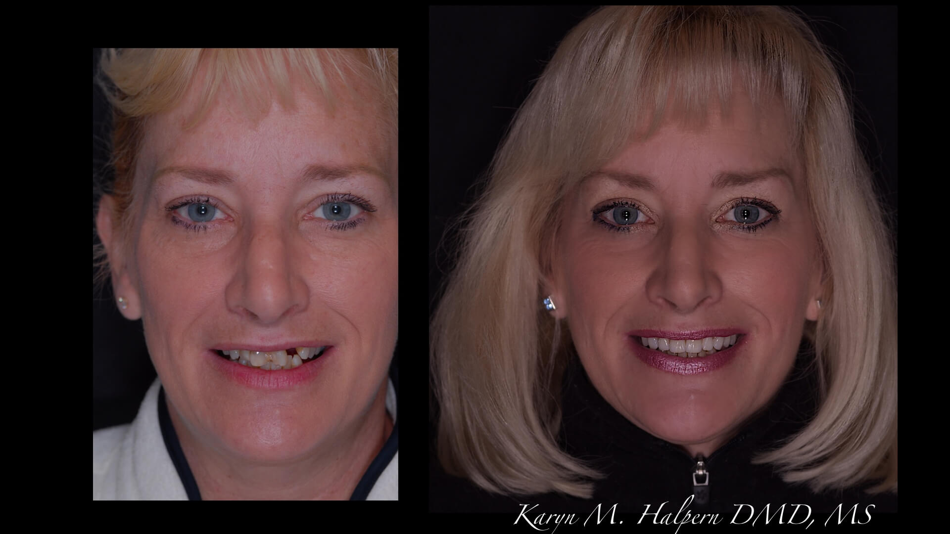 Port Jefferson Smiles-Karen Halpern DMD, MS-slider-14