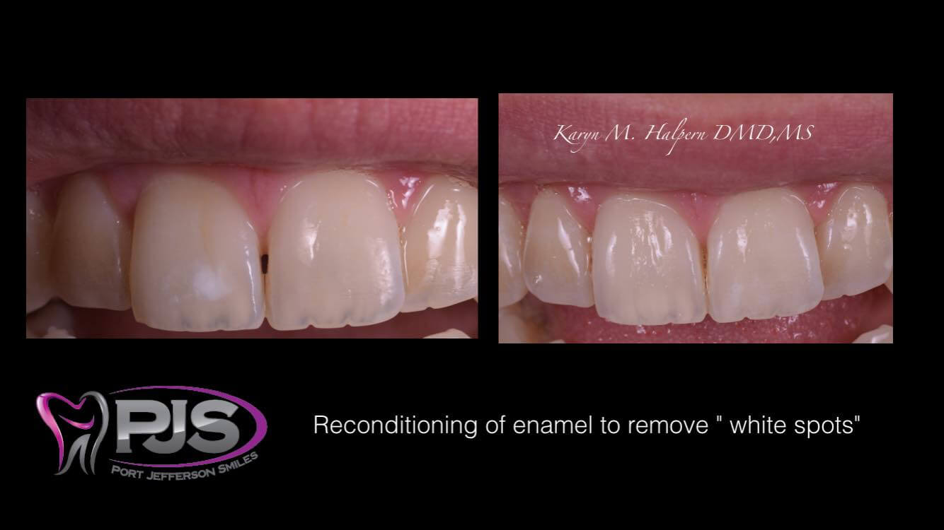 Port Jefferson Smiles-Karen Halpern DMD, MS-treatment white spot lesions