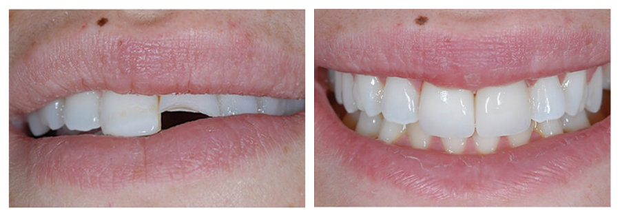 CEREC restoration - Dr. Karyn Halpern