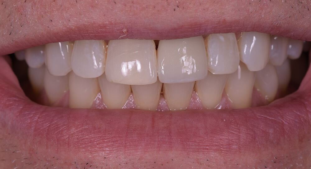 CEREC Crown - Dr. Karyn Halpern