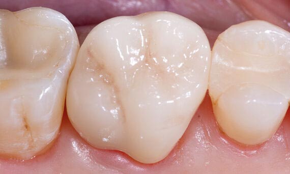 Cerec Crown - After