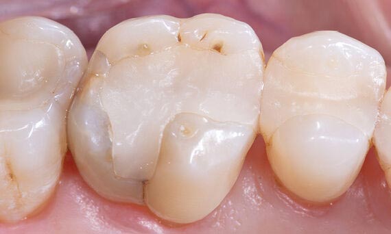 Cerec Crown - Before