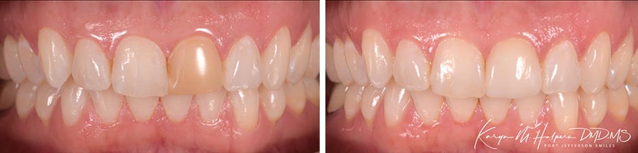 Cerec Same Day Crowns