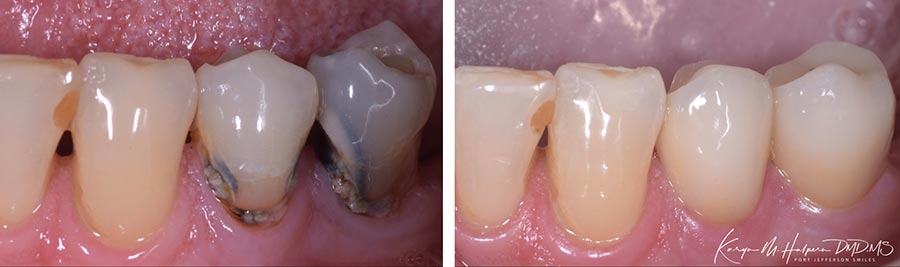 Cerec Same Day Crowns